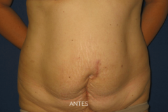 2abdominoplastia-antes3