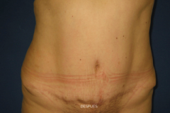 2abdominoplastia2-despues3