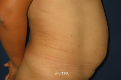 abdominoplastia2-antes