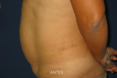 abdominoplastia2-antes2