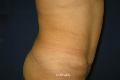 abdominoplastia2-despues