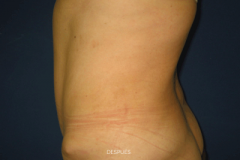 abdominoplastia2-despues2